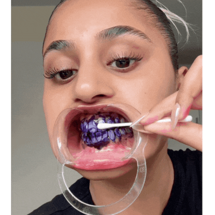 Hismile® v34 | Blanqueador Dental con Tecnología de Corrección de Color y Fórmula Sin Sensibilidad